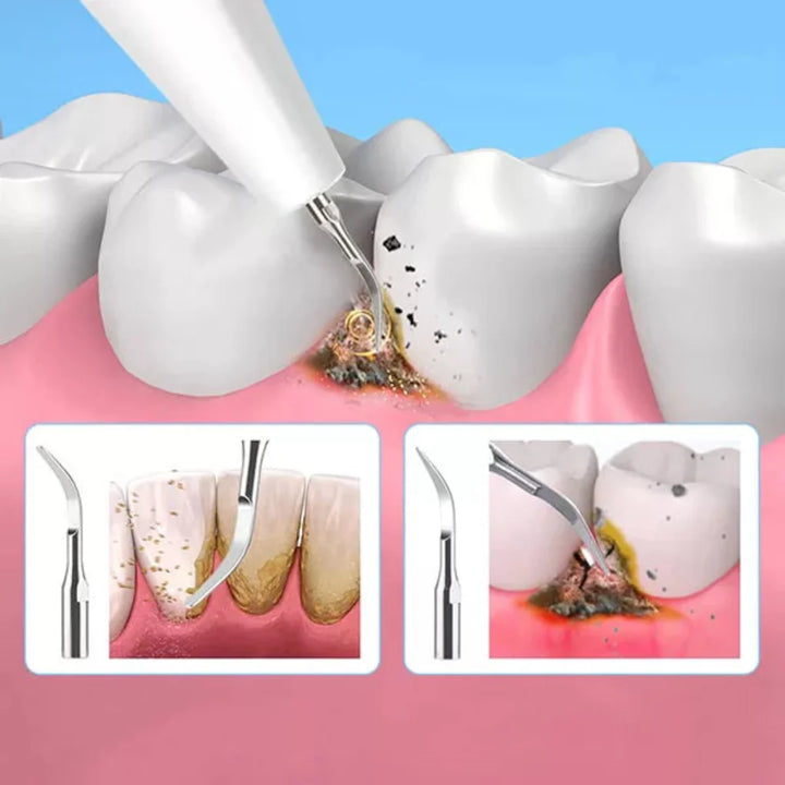 Dental Calculus Plaque Removal Tool